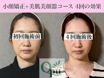 キュープ 表参道店(Qpu)/美顔器モニターコース4回の変化