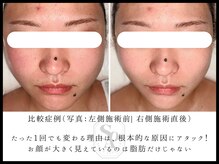 韓国肌管理室 ソア(soa)/【小顔管理症例】