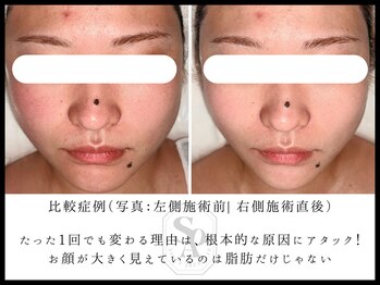 韓国肌管理室 ソア(soa)/【小顔管理症例】