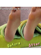ニコルル 春日部店(Nicolulu)/集中かかと&角質ケア