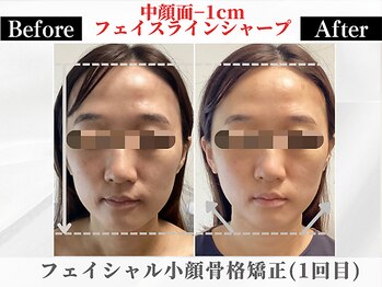 ポーベルポー(Peau Belle poe)/フェイシャル小顔矯正＋パック