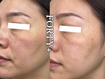 フォーティープラス(FORTY+)/施術事例