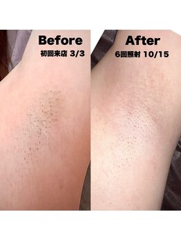 ワクシングハニー(waxing HONEY)/光脱毛器の経過