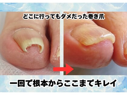巻き爪専門院002 二俣川の写真