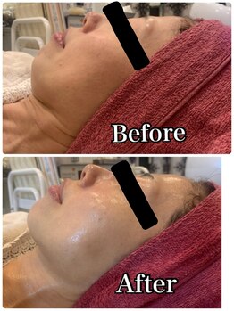 ブランシュール/小顔タイト×エンビロン