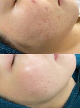 ソリッジ肌管理室/毛穴・ニキビケア