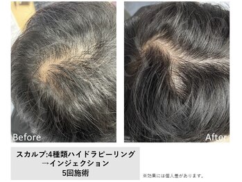 レア(Le'a)/【水素でスカルプケア】