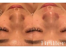 ブリエ(Briller)/毛穴洗浄＋鎮静パック