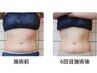 New【相談してから決めたい！】脂肪冷却×分解×キャビテーション￥19,800～