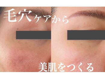 美的アヴェニール(美的.Avenir)の写真/《最高峰》針を使わず水光注入！
痛み、ダウンタイムなし◎