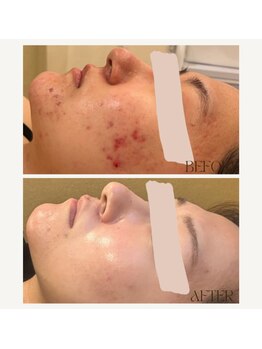 レヴ 都城店(rev)/お手軽陶器肌ピーリング