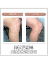 エクレ 今池店(EKURE)/脚脱毛