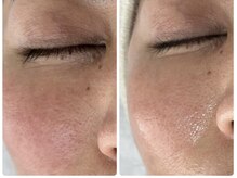 ベルエクラ(Bel Eclat)/【目の下の小じわ・赤み・毛穴】