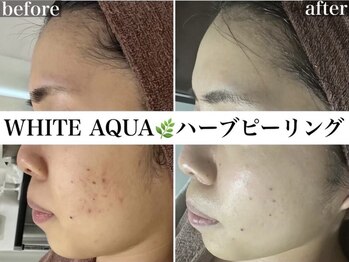 ホワイトアクア 京橋店(WHITE AQUA)/ハーブピーリング/ニキビケア