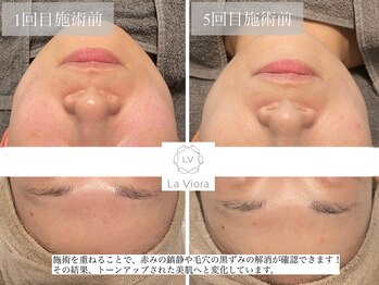 ラヴィオーラ 姫路店(La Viora)/ダイヤモンドハーブピーリング