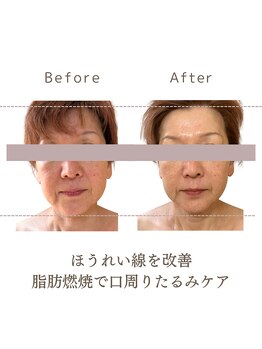 リスサロンドナース(LYS salon de Nurse)/脂肪を減らす小顔&増えるヒアル