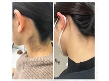 ミース 福岡本店/うなじ矯正◆ビフォーアフター