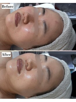 ソワナ(soina)/【神楽坂駅/フェイシャル/毛穴】