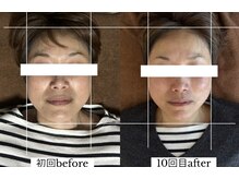 ダイアリー(DIARY)/小顔矯正