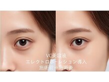 憩いサロンユリ 蕨店(Yuri)/エレクトロポーレション導入