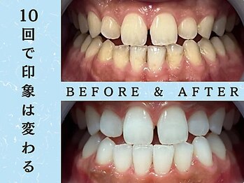 ホワイトニングショップ 八王子店/八王子セルフホワイトニング