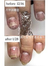 チアロ(Chiaro)/爪甲剥離痛くもなくて気付かない