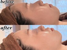 ディオーネ 西船橋駅前店(Dione)/美肌顔脱毛◇Before After