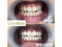 ルブラン 奈良店(Le Blanc)/どのくらいで白くなる？