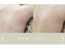 サロンドシュシュ 心斎橋本店(salon de chouchou)/REVI背中剥けないハ-ブピ-リング