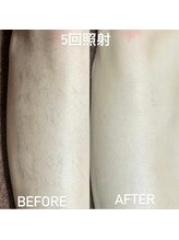 ココ(Coco)/足脱毛