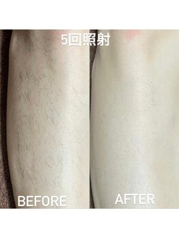 ココ(Coco)/足脱毛