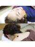 【2回目以降/身体&美容セットで2000円お得に♪】身体の鍼灸＋美容鍼50本¥9000