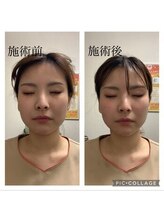 だるま整骨院/美容鍼の効果