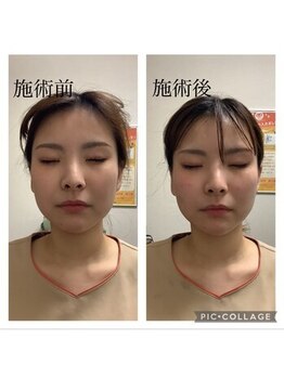 だるま整骨院/美容鍼の効果