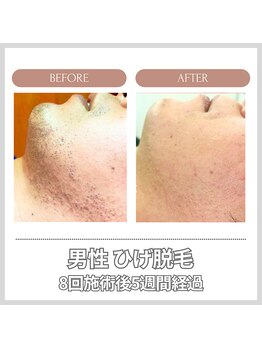 エクレ 今池店(EKURE)/ヒゲ脱毛