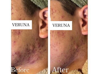 MMK/学生もコツ2ハーブピーリング☆