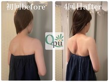 キュープ 福岡天神店(Qpu)/巻肩矯正４回での変化