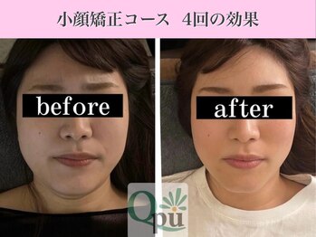 キュープ 表参道店(Qpu)/小顔矯正4回コースの変化