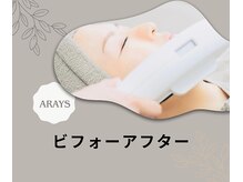 アレイズ(ARAYS)/症例はこちら