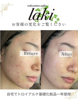 リラクゼーションサロン ラキ(laki)/トロイアルケ　スキンメイド