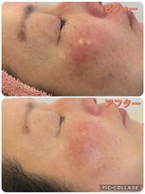 サロンドラニ(salon de LANI)/【シミケア】症例