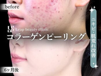 リープ(Leap)/コラーゲンピーリング