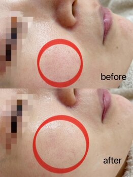 シェリー(Cheri)/鼻+ホホ毛穴洗浄吸引+酵素ピール