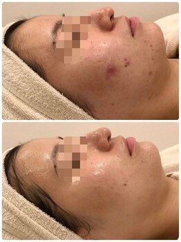 ベルミナ(BE.LMINA)/ニキビケア