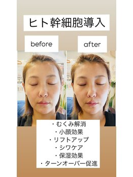 リベル(Liber)/ヒト幹細胞導入でエイジング効果