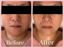 スイ 昭島店(Sui)/超音波＋ハーブピーリング