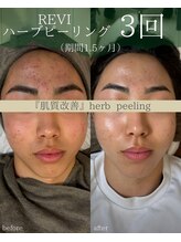 シツ(SHITSU)/ハーブピーリング『３回の変化』