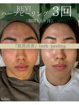 シツ(SHITSU)/ハーブピーリング『３回の変化』