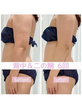 ペルラペティーユ(PERLA PETILLER)/背中＋二の腕：６回