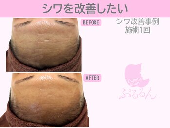 ぷるるんエステ/毛穴/小顔/フェイシャル